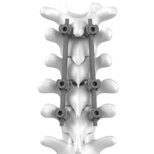 Sistema di osteosintesi cervico-toracico - C.T.J - NEURO FRANCE Implants - via posteriore / per adulti