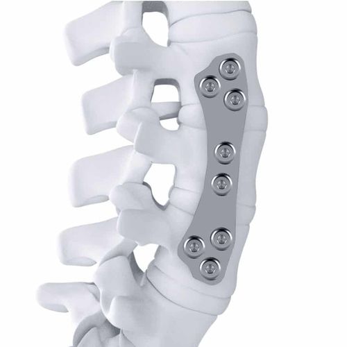 Placca per artrodesi lombare - ARTHEMIS - NEURO FRANCE Implants - toraco-lombare / anterolaterale / in titanio