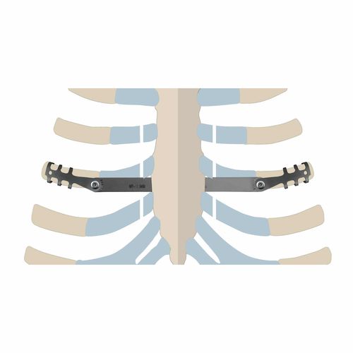 Placca di compressione per costole - ThoRib® PECTUS - NEURO FRANCE Implants - in titanio / pediatrica