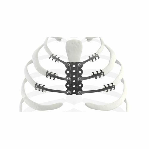 Protesi costale per ricostruzione dopo resezione di osteosarcoma - TRIONYX® - NEURO FRANCE Implants