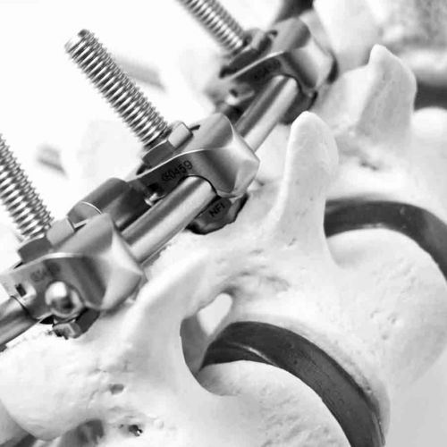 Sistema di osteosintesi toraco-lombare - S.E.S+ - NEURO FRANCE Implants - via posteriore / per adulti