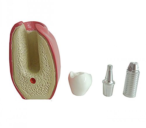 Modello anatomico odontoiatrico - 9764  - Nacional Ossos - per implantologia / per protesistica dentale / ad uso didattico