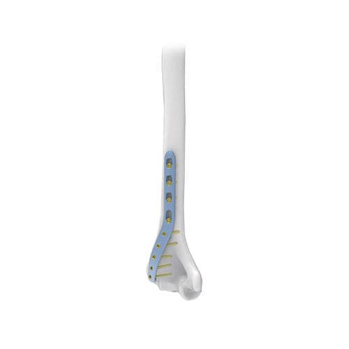 Placca di compressione per omero - NORMMED Medical Devices - distale / bloccata / in metallo