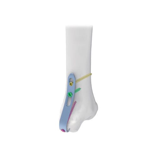 Placca di compressione per malleolo - NORMMED Medical Devices - mediale / bloccata / in metallo