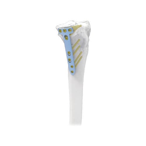 Placca per osteotomia per tibia - NORMMED Medical Devices - bloccata / in metallo