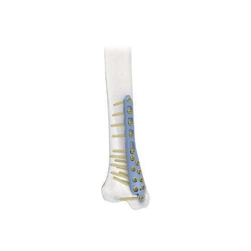 Placca di compressione per tibia - PNM1014 - NORMMED Medical Devices - distale / mediale / bloccata