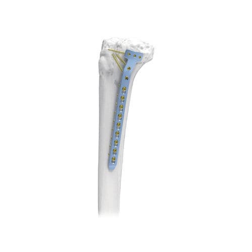 Placca di compressione per tibia - PNM1054-TP2 - NORMMED Medical Devices - prossimale / mediale / bloccata