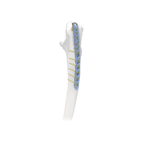 Placca di compressione per olecrano - PNM1042 - NORMMED Medical Devices - bloccata / in metallo