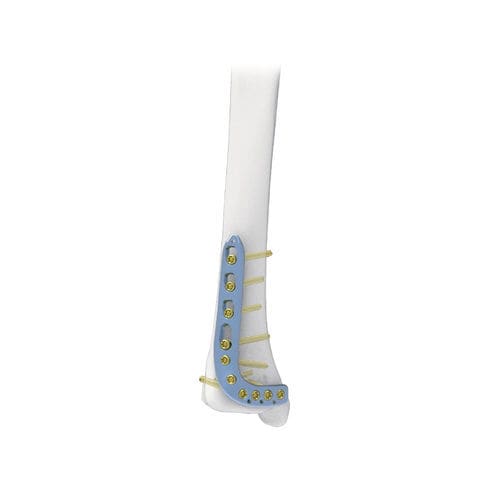 Placca di compressione per tibia - PNM1015 - NORMMED Medical Devices - distale / anterolaterale / bloccata