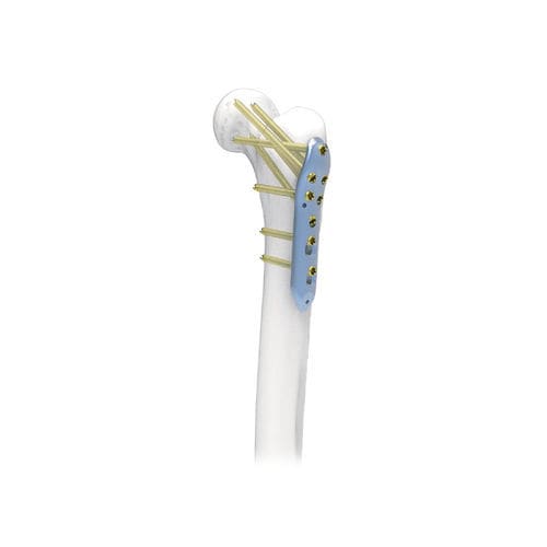 Placca di compressione per femore - NORMMED Medical Devices - prossimale / bloccata / in metallo