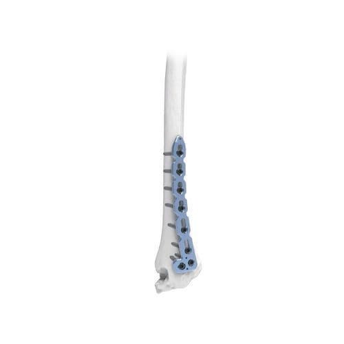 Placca di compressione per radio - PNM1041 - NORMMED Medical Devices - distale / dorsale / bloccata