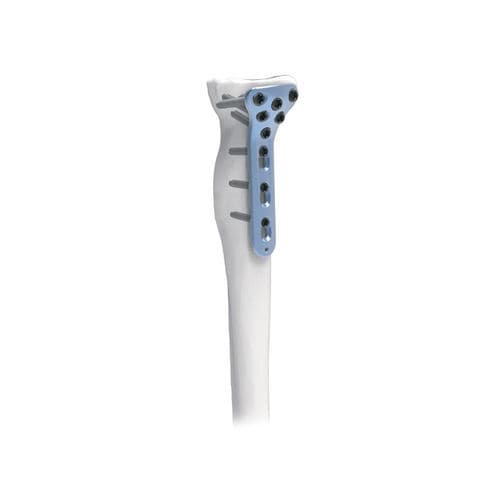 Placca di compressione per radio - PNM1034 - NORMMED Medical Devices - prossimale / bloccata / in metallo