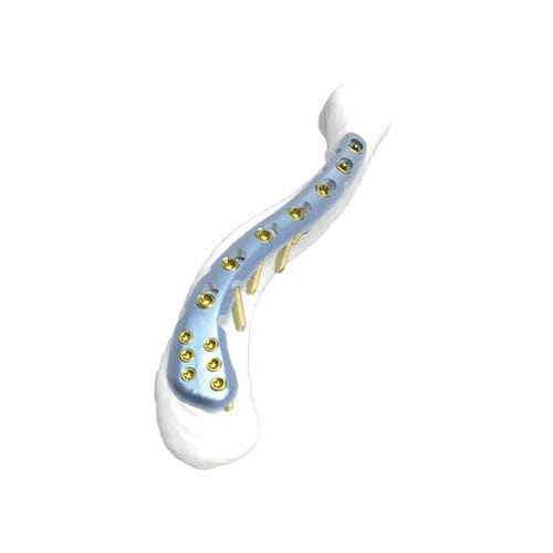 Placca di compressione per clavicola - PNM1001 - NORMMED Medical Devices - distale / bloccata / in metallo