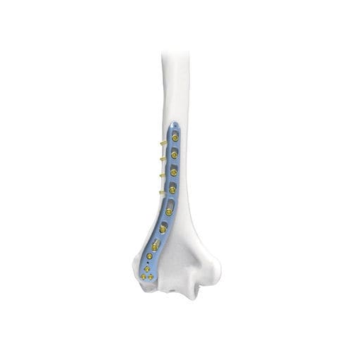 Placca di compressione per omero - NORMMED Medical Devices - distale / posterolaterale / bloccata