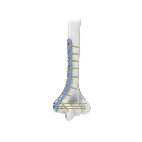 Placca di compressione per omero - PNM1005 - NORMMED Medical Devices - distale / mediale / bloccata