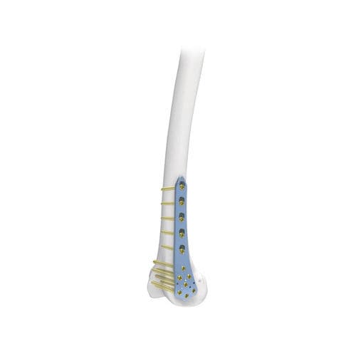Placca di compressione per femore - PNM1022 - NORMMED Medical Devices - distale / bloccata / in metallo
