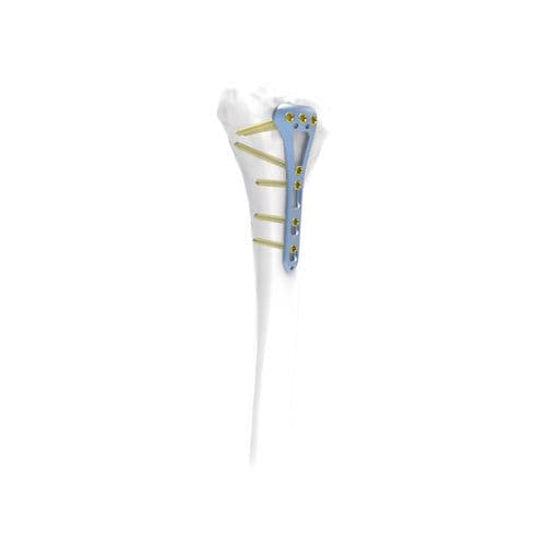 Placca di compressione per tibia - NORMMED Medical Devices - distale / posterolaterale / bloccata
