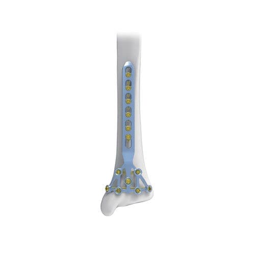 Placca di compressione per tibia - Pilon - NORMMED Medical Devices - bloccata / in metallo