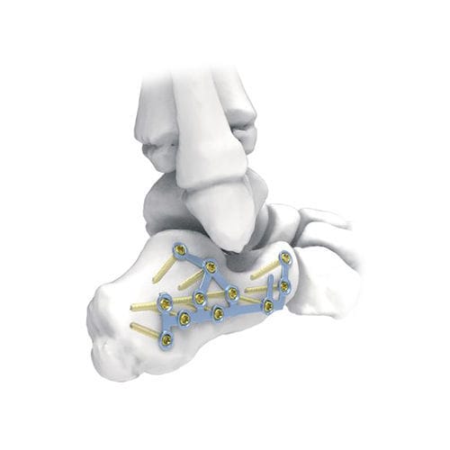Placca di compressione per calcagno - PNM1032 - NORMMED Medical Devices - bloccata / in metallo