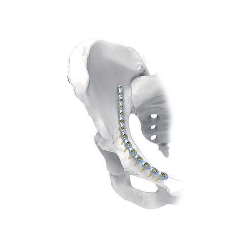 Placca di compressione per bacino - J - NORMMED Medical Devices - bloccata / in metallo
