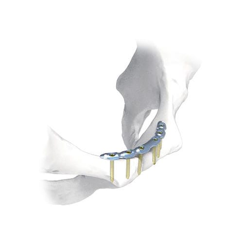 Placca di compressione per bacino - NORMMED Medical Devices - bloccata / in metallo