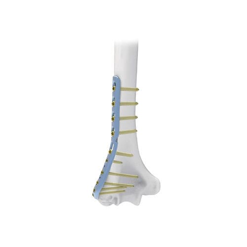 Placca di compressione per omero - NORMMED Medical Devices - distale / laterale / bloccata