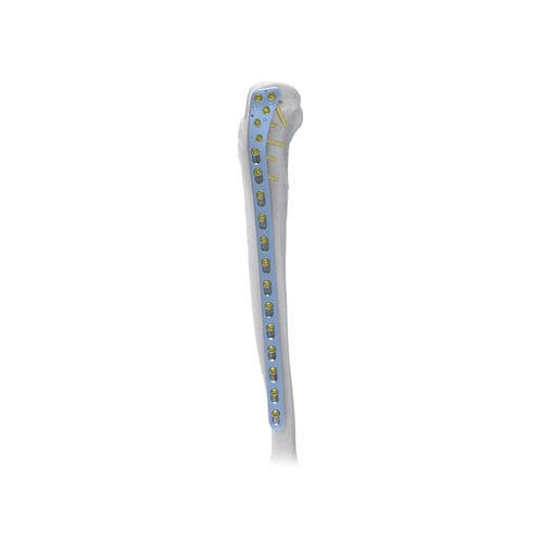 Placca di compressione per tibia - Large  - NORMMED Medical Devices - prossimale / laterale / bloccata