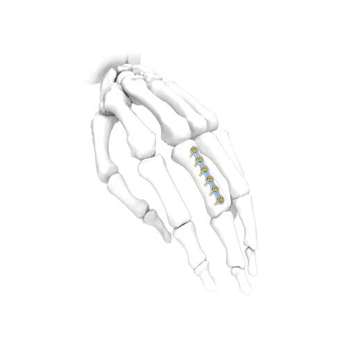 Placca di compressione per mano - PNM5002 - NORMMED Medical Devices - bloccata / in metallo
