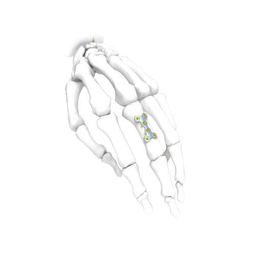 Placca di compressione per mano - PNM5006-022 - NORMMED Medical Devices - bloccata / in metallo