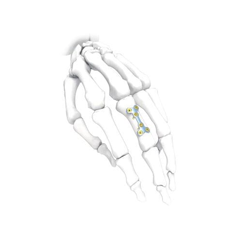 Placca di compressione per mano - PNM5006-032 - NORMMED Medical Devices - bloccata / in metallo