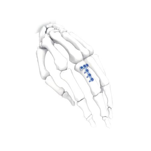 Placca di compressione per mano - PNM5009 - NORMMED Medical Devices - bloccata / in metallo
