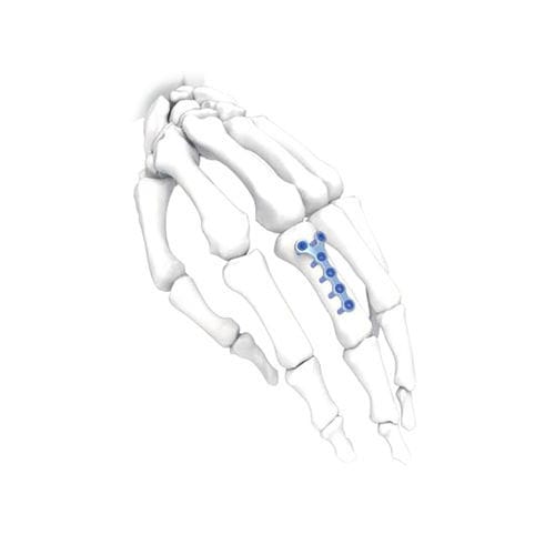 Placca di compressione per mano - Y  - NORMMED Medical Devices - bloccata / in metallo