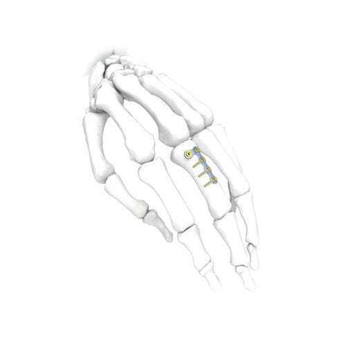 Placca di compressione per mano - L  - NORMMED Medical Devices - bloccata / in metallo