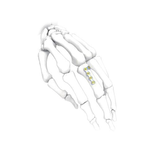 Placca di compressione per mano - NORMMED Medical Devices - bloccata / in metallo