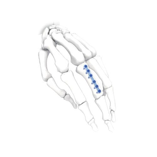 Placca di compressione per mano - Long - NORMMED Medical Devices - per piede / bloccata / in metallo