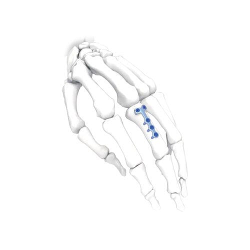 Placca di compressione per mano - T - NORMMED Medical Devices - per piede / bloccata / in metallo