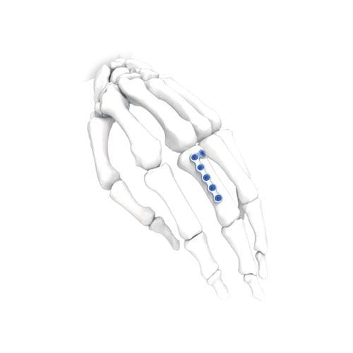Placca di compressione per mano - PNM5012-100 - NORMMED Medical Devices - per piede / bloccata / in metallo