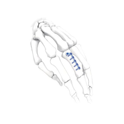 Placca di compressione per mano - L Oblique  - NORMMED Medical Devices - per piede / bloccata / in metallo