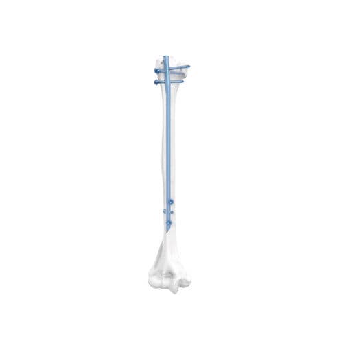 Chiodo intramidollare per omero - NORMMED Medical Devices - fissazione diafisaria / fissazione prossimale / in metallo
