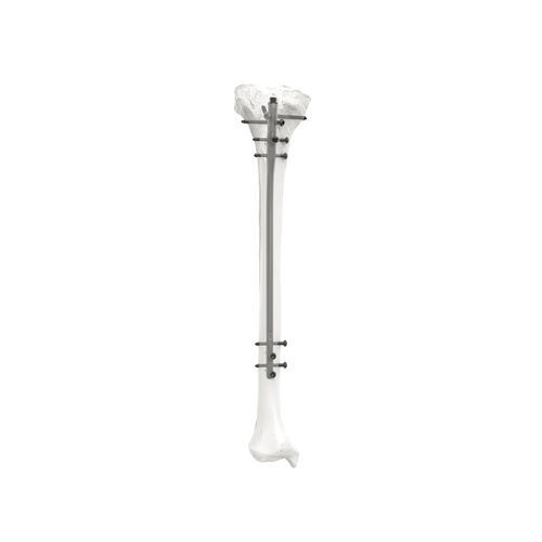 Chiodo intramidollare per tibia - PNM3308 - NORMMED Medical Devices - fissazione diafisaria / fissazione prossimale / in metallo