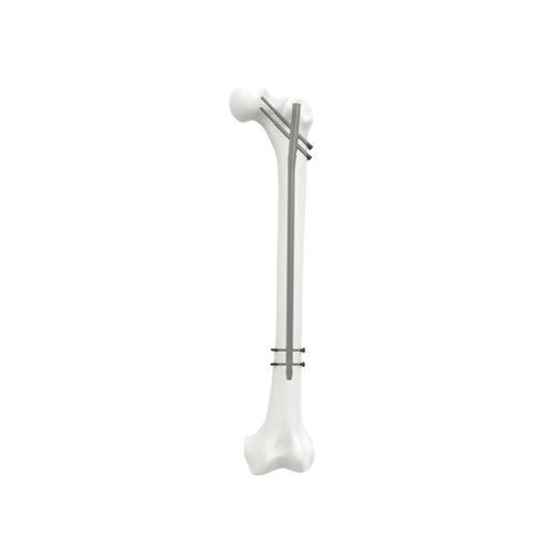 Chiodo intramidollare per femore - NORMMED Medical Devices - fissazione prossimale / fissazione diafisaria / in metallo