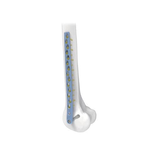 Placca di compressione per cotile femorale - NORMMED Medical Devices - bloccata / in metallo