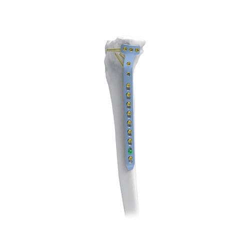 Placca di compressione per tibia - NORMMED Medical Devices - prossimale / mediale / bloccata