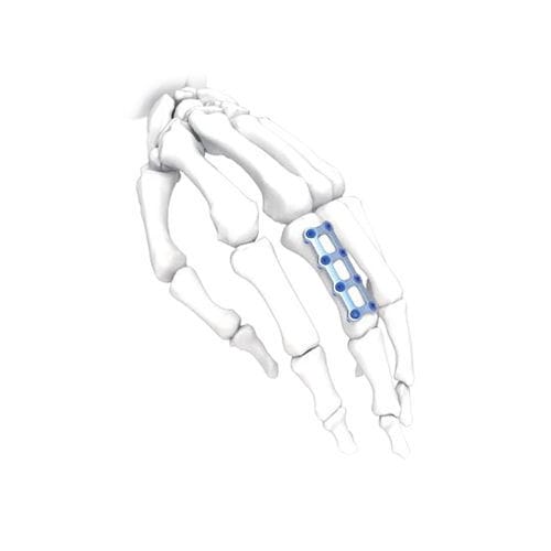 Placca di compressione per mano - Mini  - NORMMED Medical Devices - bloccata / in metallo