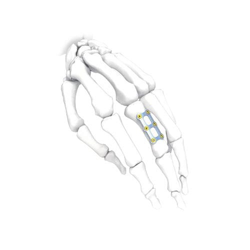 Placca di compressione per mano - H Short - NORMMED Medical Devices - per piede / bloccata / in metallo