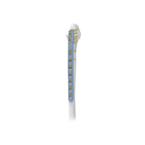 Placca di compressione per fibula - PNM1017 - NORMMED Medical Devices - distale / posterolaterale / bloccata