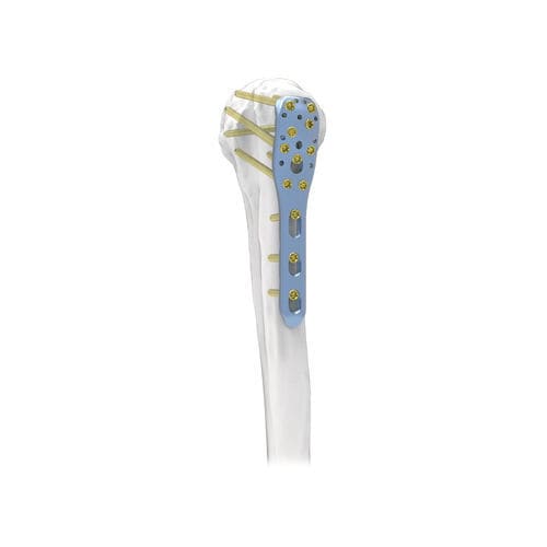 Placca di compressione per omero - PNM1004 - NORMMED Medical Devices - prossimale / bloccata / in metallo