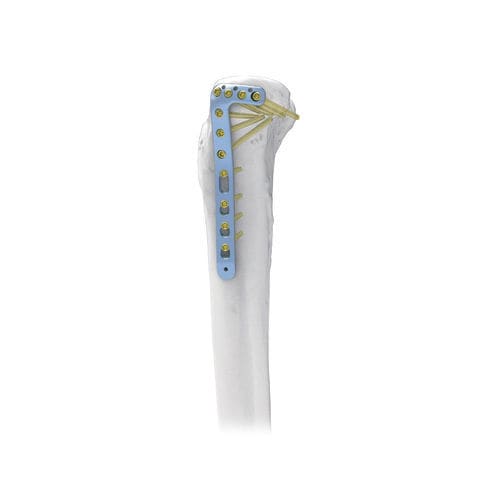 Placca di compressione per tibia - NORMMED Medical Devices - prossimale / laterale / bloccata