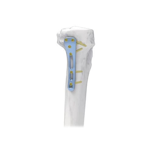 Placca di compressione per tibia - NORMMED Medical Devices - prossimale / posteromediale / bloccata