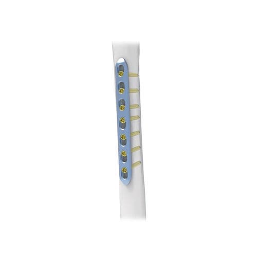 Placca di compressione per piccoli frammenti ossei - NORMMED Medical Devices - bloccata / in metallo